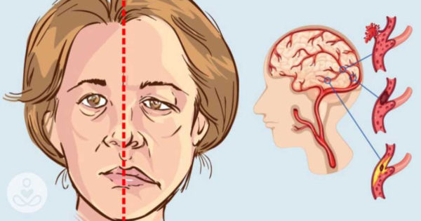 15 semne pe care corpul tau le resimte înainte cu până la o luna de un accident vascular cerebral