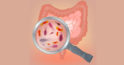 5 moduri de a restabili microflora intestinală pentru a normaliza digestia
