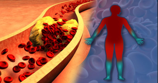 Simptomul periculos al colesterolului ridicat, care trebuie identificat înainte să fie prea târziu
