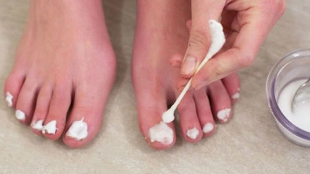 cum să reparați unghiile de la picioare după ciupercă
