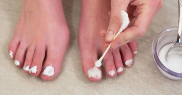 vindeca eficient ciupercile de pe unghiile picioarelor