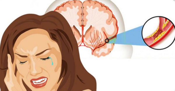 10 semne că ați experimentat deja un accident vascular cerebral „ascuns” – și cel mai rău urmează să vină
