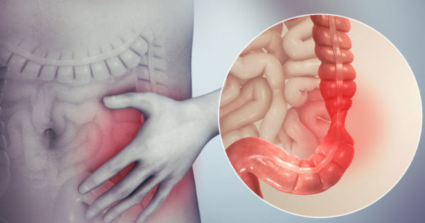 Sindromul intestinului leneș sau colonul iritabil