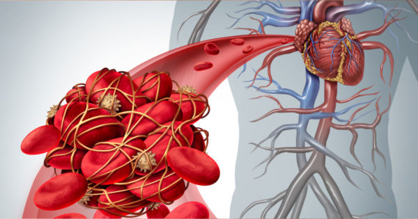 Simptome ale cheagurilor de sânge la diferite organe: cum să vă dați seama dacă aveți unul