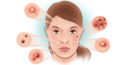 6 tipuri de acnee și posibile cauze