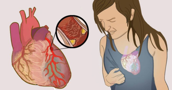Se pare că un atac de cord la femei se manifestă diferit: 5 simptome ciudate și neașteptate, care nu pot fi ignorate
