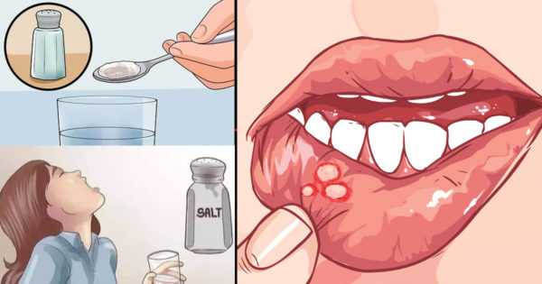 Remedii naturiste pentru stomatita și ulcerele bucale