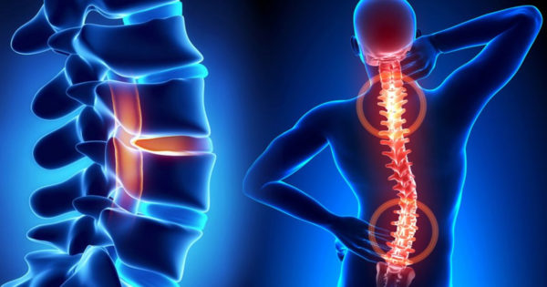 Osteocondroza, tipuri și cauze ale durerilor de spate