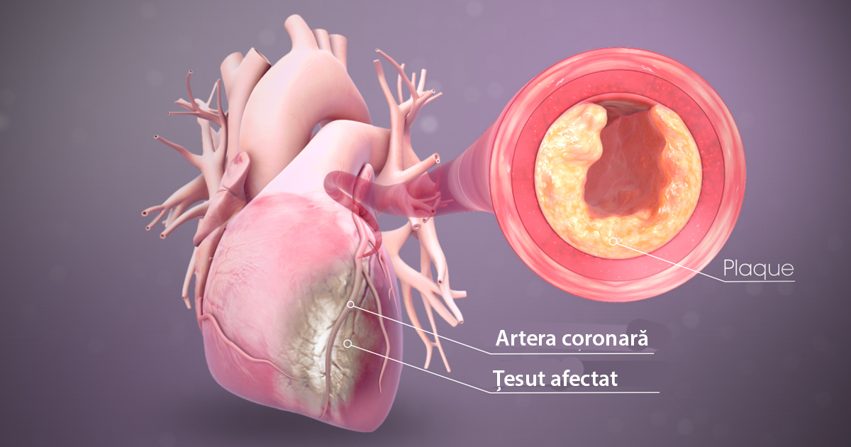 Infarctul miocardic simptomele sale „tăcute” în loc de durerea