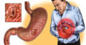 Propolisul tratează stomacul și intestinele: tratament eficient și simplu