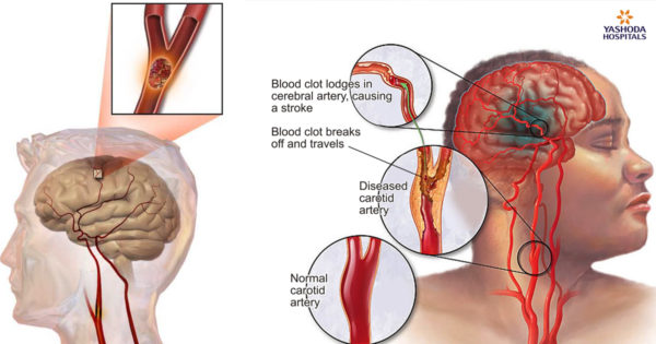 Accidentul vascular cerebral: un simptom în timpul mersului care poate fi primul semnal