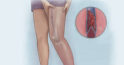 Tromboză: 5 semne posibile ale unui cheag de sânge la nivelul piciorului care necesită atenție