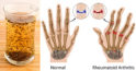 6 remedii naturale pentru durerile de artrită ale mâinilor