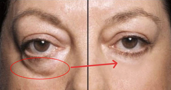 5 remedii pentru reducerea cearcănelor de sub ochi