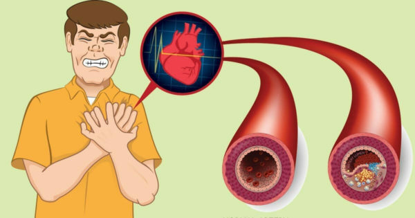 10 alimente naturale care ajută la curățarea arterelor și prevenirea atacului de cord