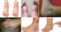 Edemul periferic – De ce se umflă mâinile și picioarele: 12 motive atât inofensive, cât și periculoase