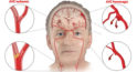 Accident vascular cerebral silențios: simptome de avertizare și factori de risc.