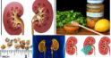 Top 10 alimente care ne ajută în cazul pietrelor la rinichi