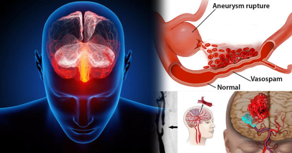 Ce este spasmul cerebrovascular? Simptome, cauze și tratamente