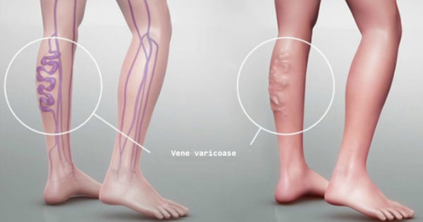 Varicele: de unde vine „boala vedetă” a picioarelor și cum poți scăpa de ea