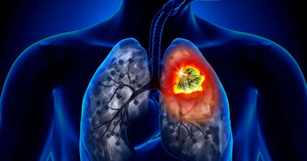 Aerul toxic al orașelor de umple plămânii cu substanțe nocive. Cum poți face detoxifiere pulmonară utilizând remediile naturiste din bătrâni