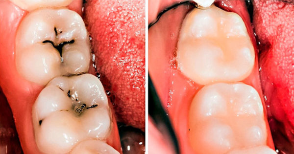 Încă mai crezi în zâna dinților? Este timpul să te transformi tu în ea! 7 metode simple pentru prevenirea naturală a cariilor și a problemelor de la nivelul dinților