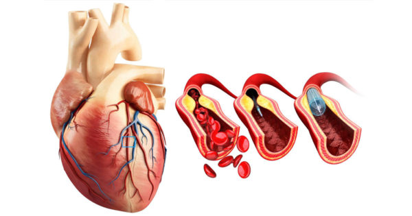 Cum să restabiliți sănătatea inimii și vaselor de sânge