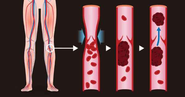 Cum se manifestă tromboza și ce să faci dacă s-a format un cheag de sânge