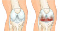 Gonartroza: simptome și tratamentul artrozei deformante a articulației genunchiului