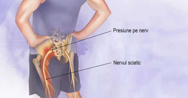Durerea care se lasă pe picior: 2 metode simple pentru a ameliora durerea și a debloca nervul sciatic